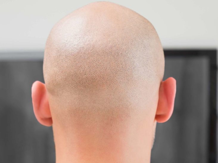Alopecia Areata Causes Symptoms And Treatment