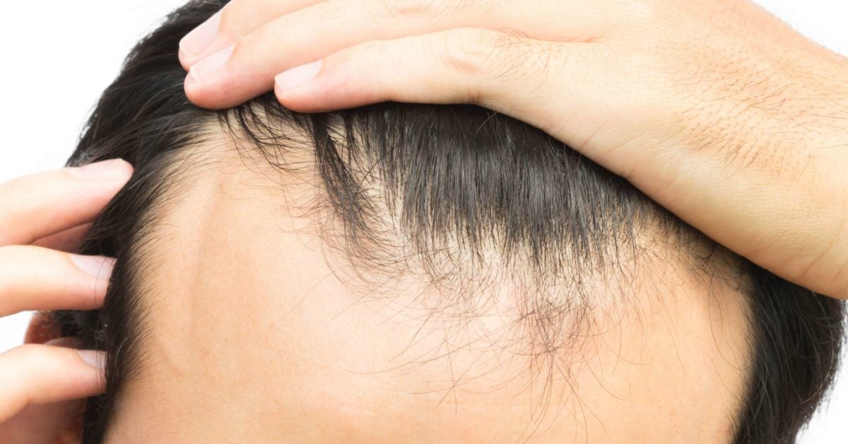 Receding Hairline Treatment Stages And Causes