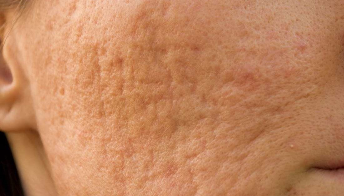 skin pock marks