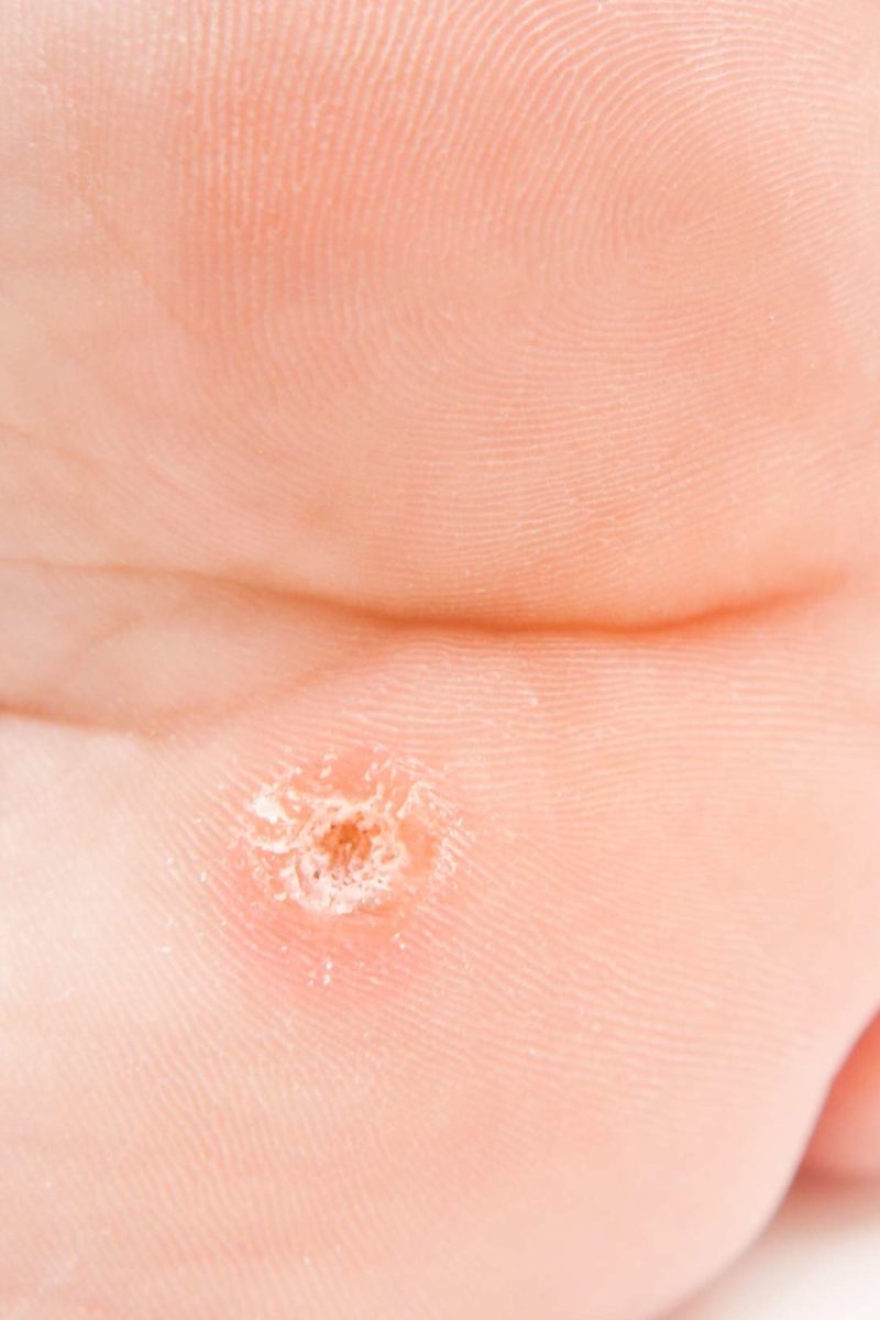 Hyperkeratosis: Causes, symptoms, and treatment