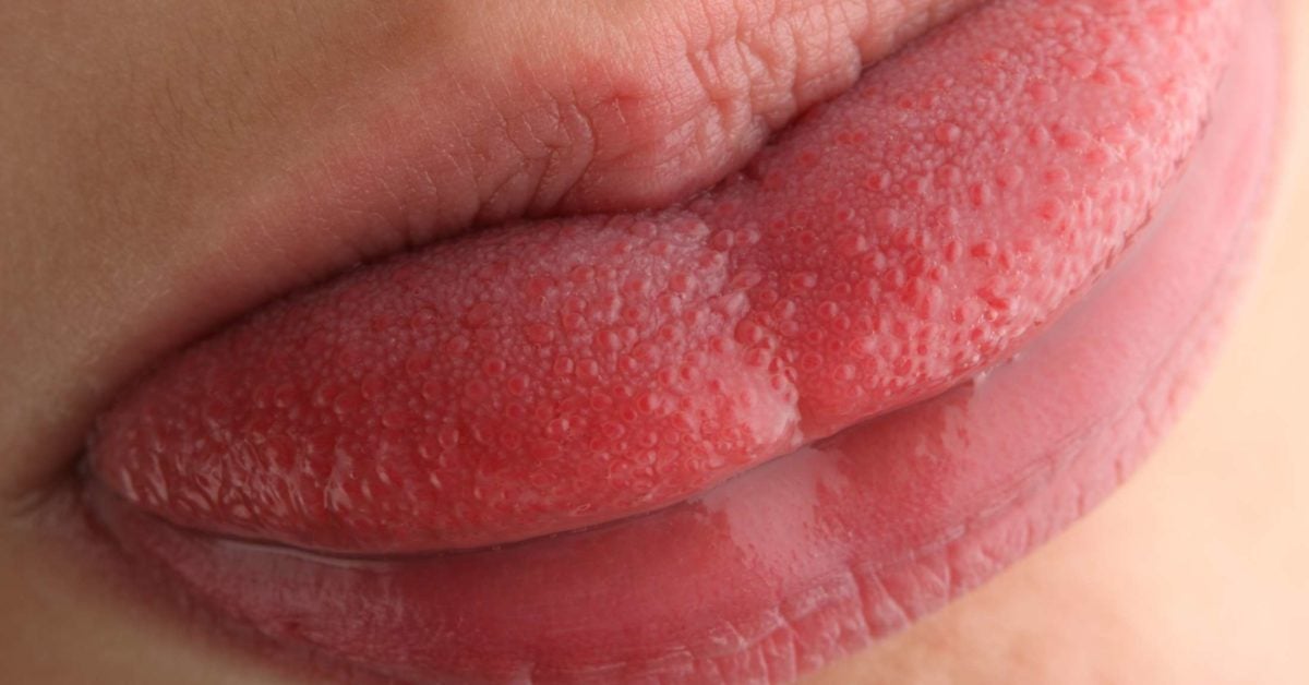 inflammation of tongue papillae)