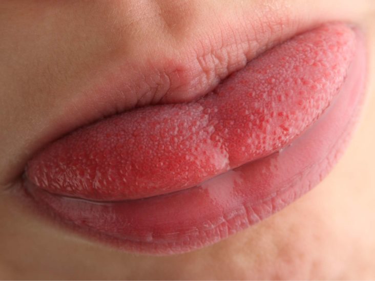 Hairy Tongue Symptoms Causes And Treatment