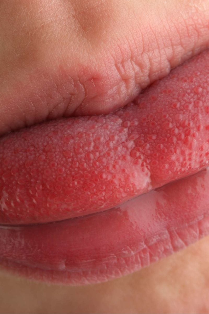 What Causes Swollen Taste Buds On Your Tongue