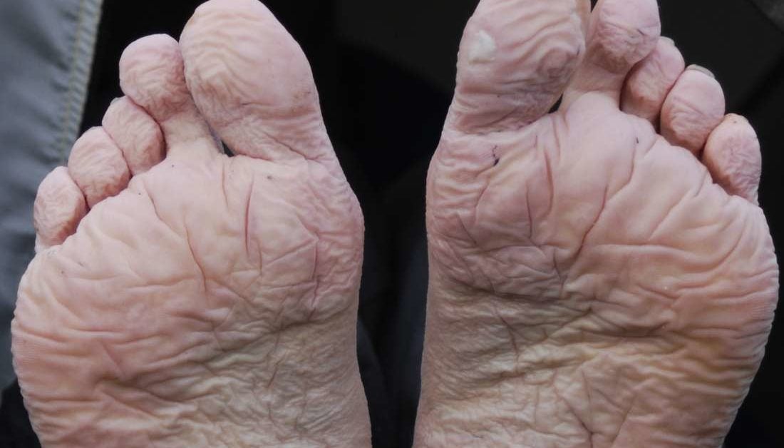 Trench Foot Symptoms Causes Treatment Trench Foot Symptoms Causes Treatment