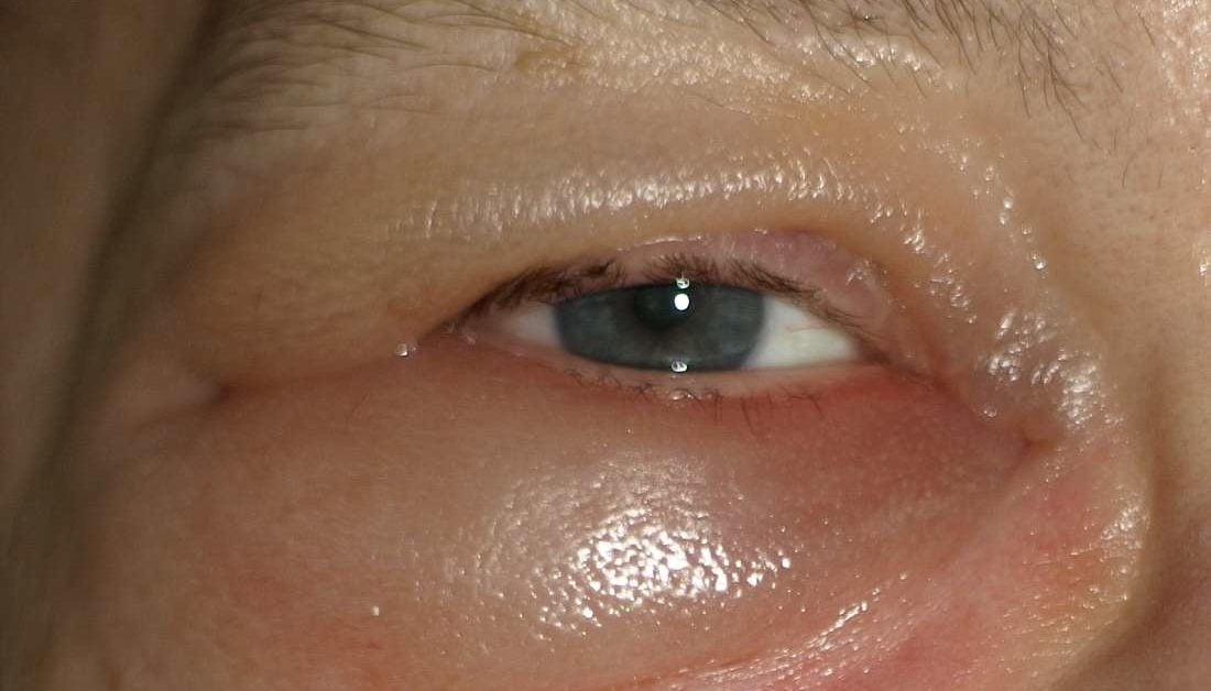 What Causes Swelling Around The Eyes