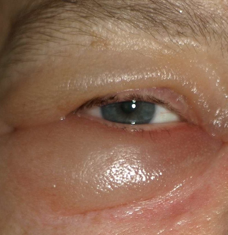 How To Get Rid Of Edema Around Eyes