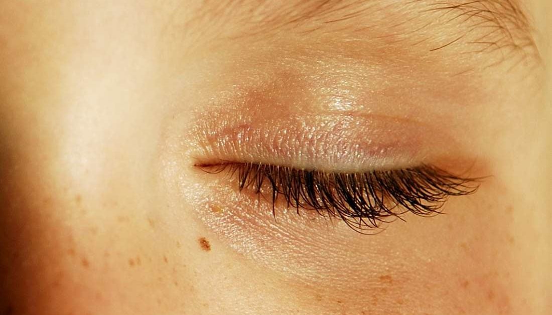 swollen-eyelid-symptoms-treatment-pictures-causes-hubpages