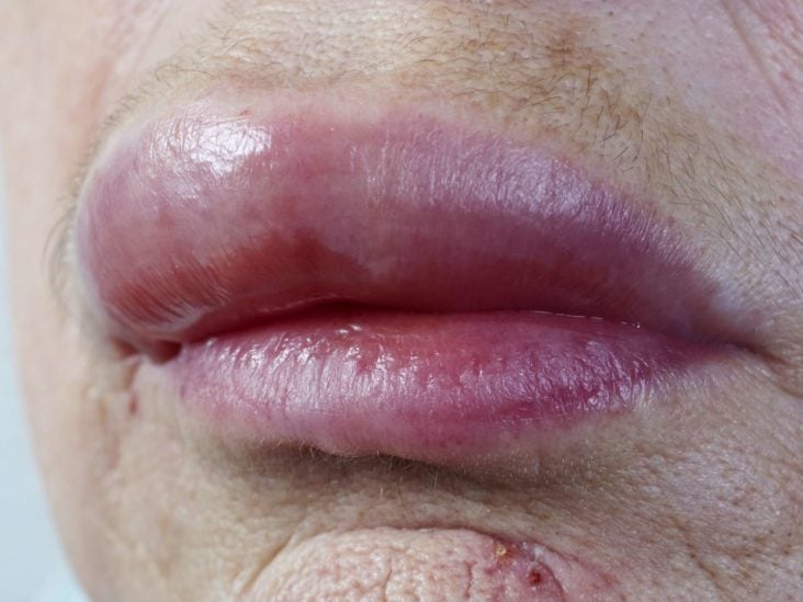 Allergic Reaction On Face Treatment Causes And Symptoms