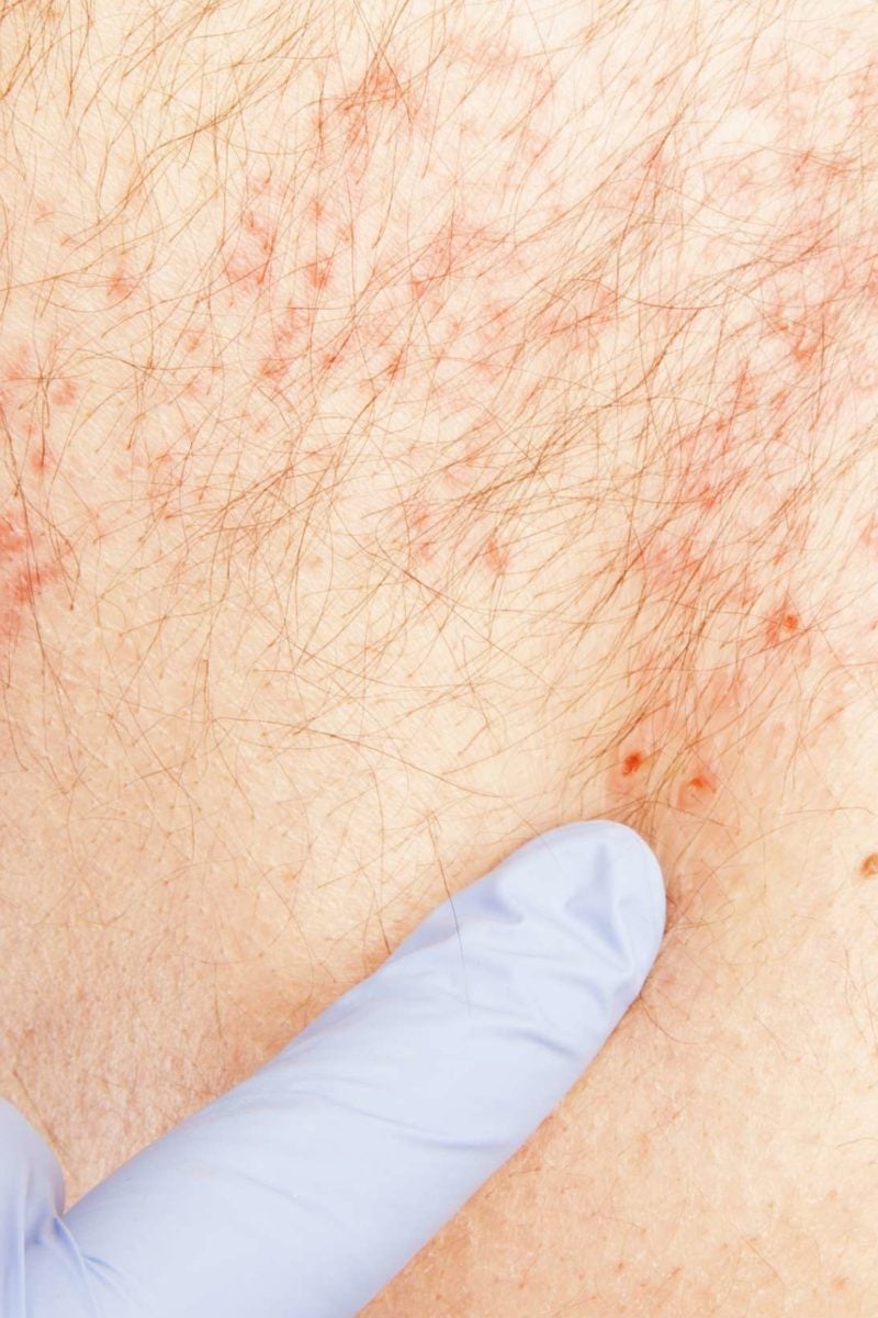 how long do shingles last after medication