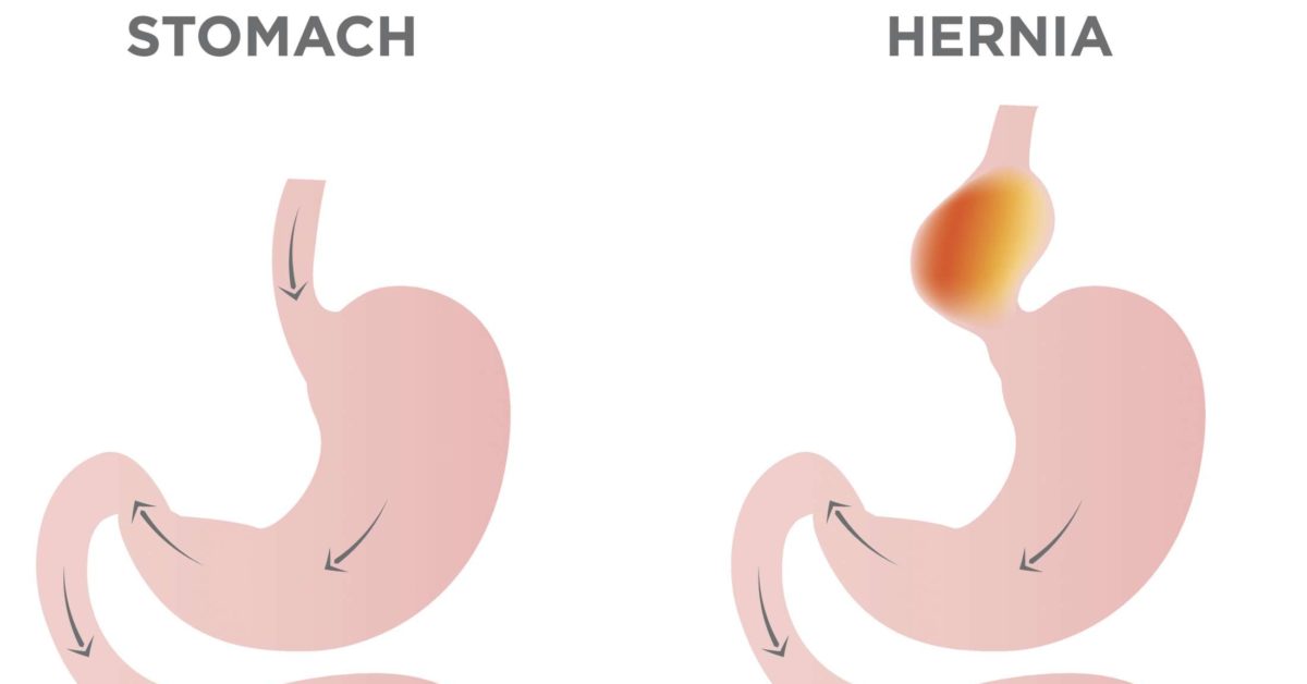 Hiatal Hernia Surgery Procedure Recovery And Outlook