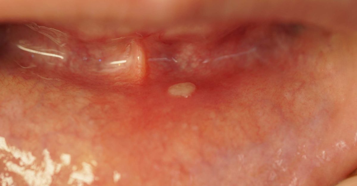 white-spots-on-gums-a-symptom-of-leukoplakia