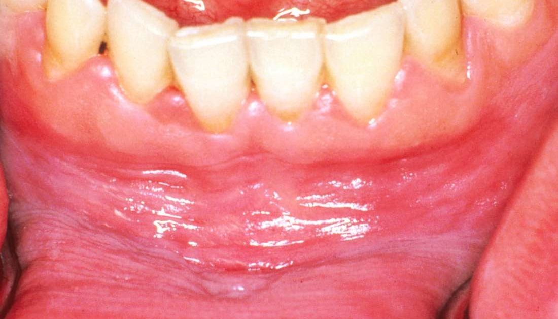 white-patch-on-gums-after-tooth-extraction