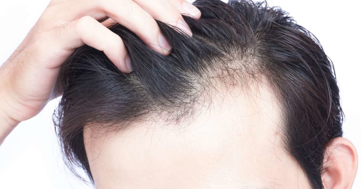 Vitamin D Deficiency Hair Loss Symptoms And Treatment