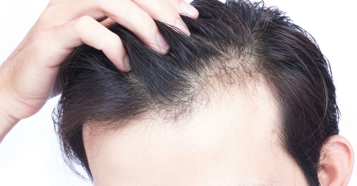 Vitamin D deficiency hair loss: Symptoms and treatment