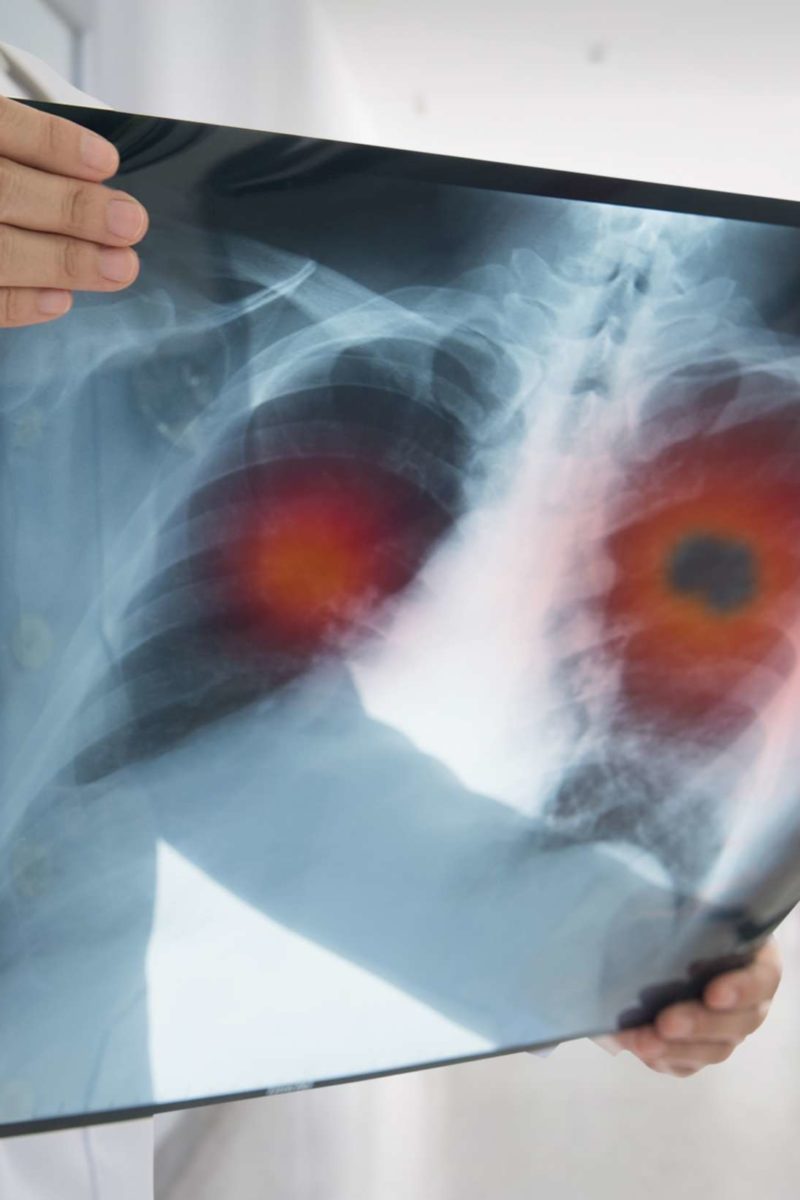 why-is-lung-cancer-so-difficult-to-treat