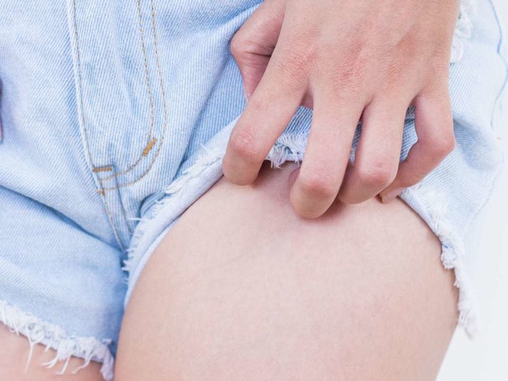 ketoconazole for diaper rash