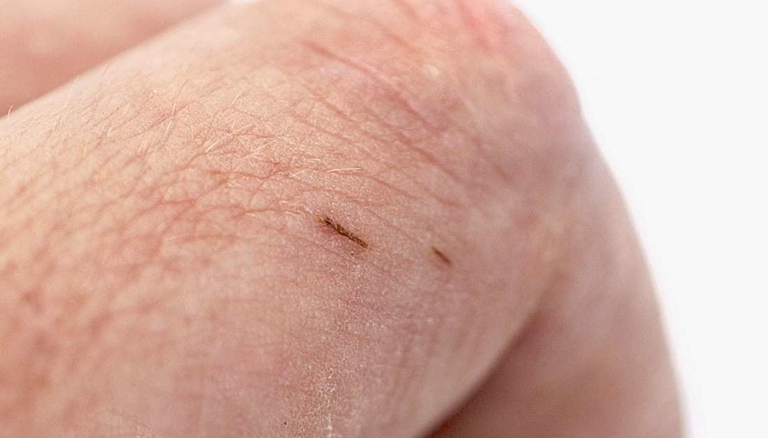 How to remove a splinter Methods and tips