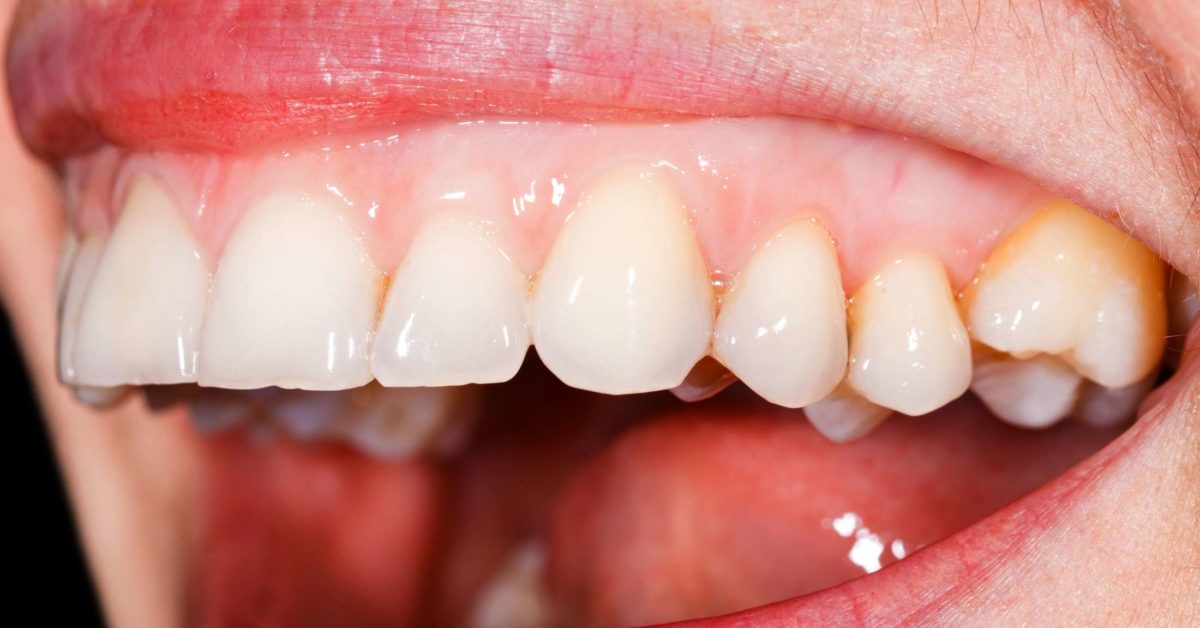 pale-gums-causes-symptoms-treatment-and-warning-signs