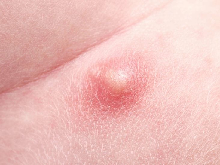 6 Ways To Treat Razor Bumps Fast