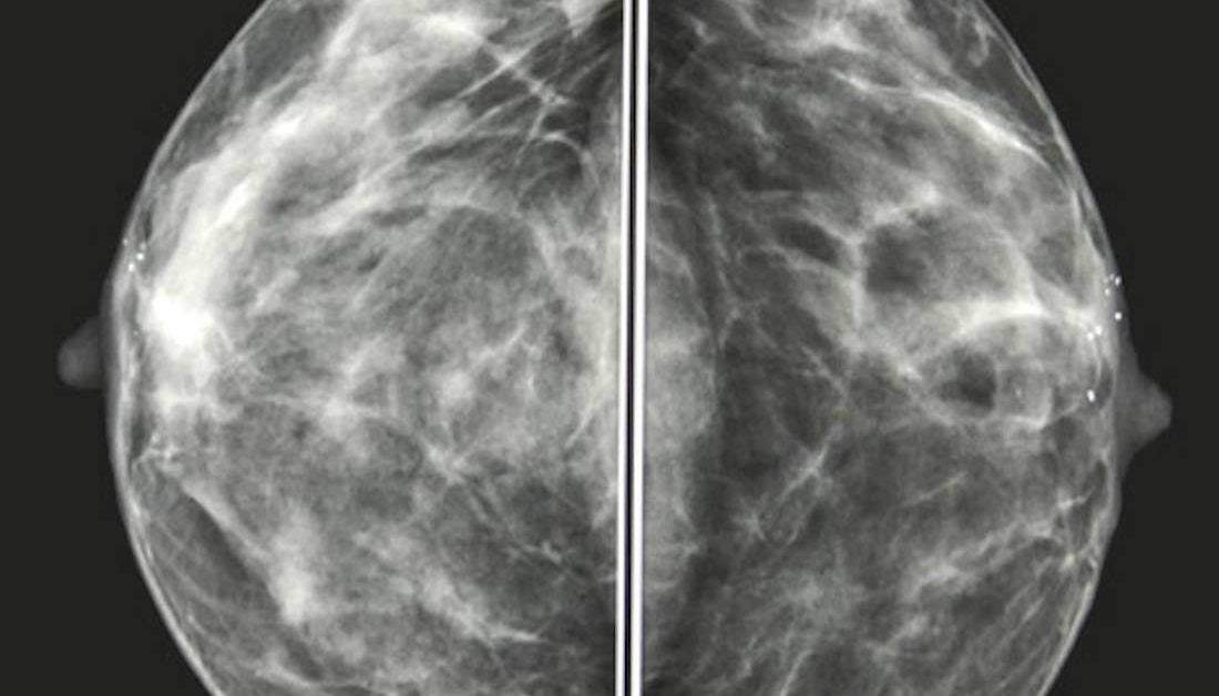 pain-and-breast-cancer-huffpost