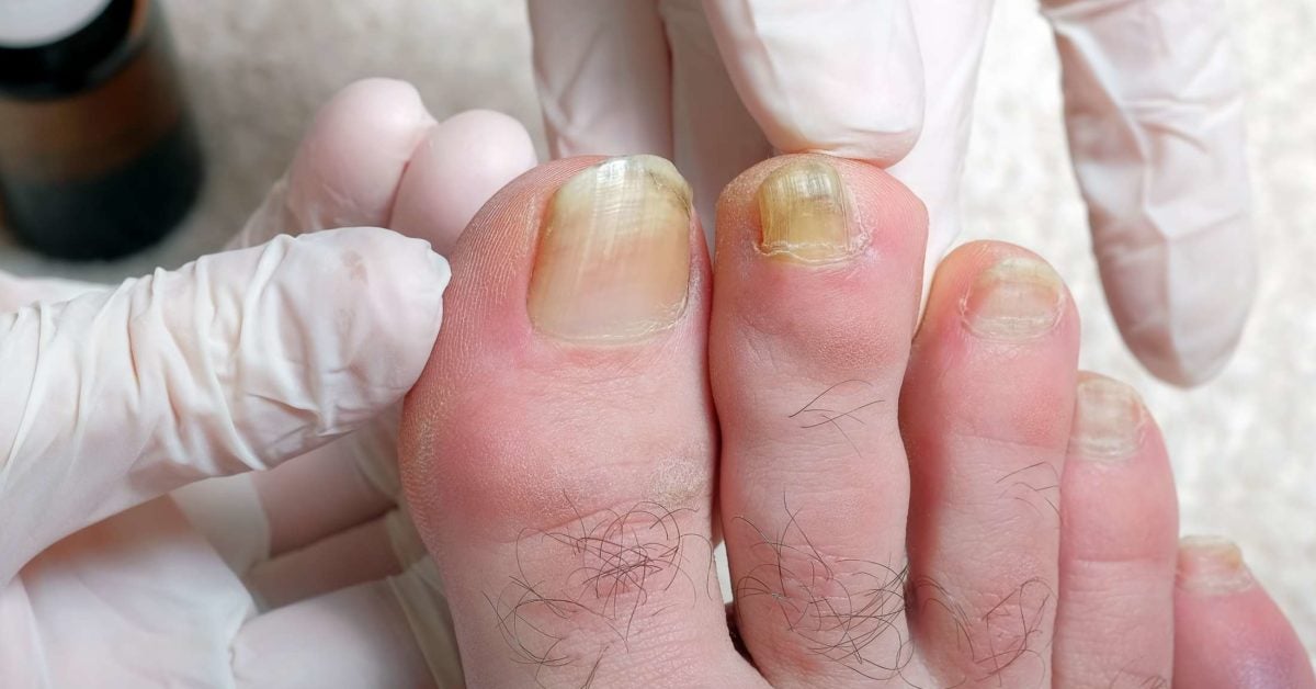 present-podiatry-online-cme-conferences-toe-nail-discoloration-and