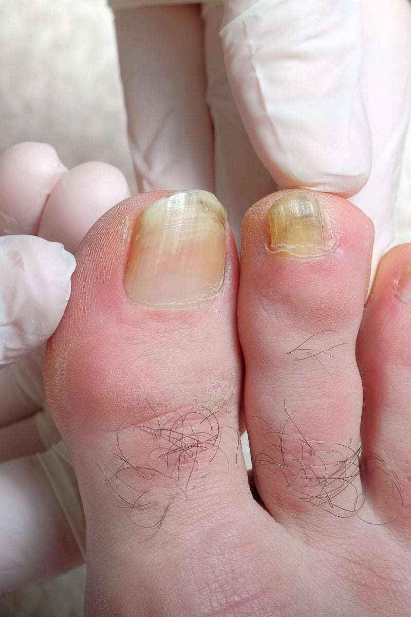 what-do-white-spots-on-toenails-mean-design-talk