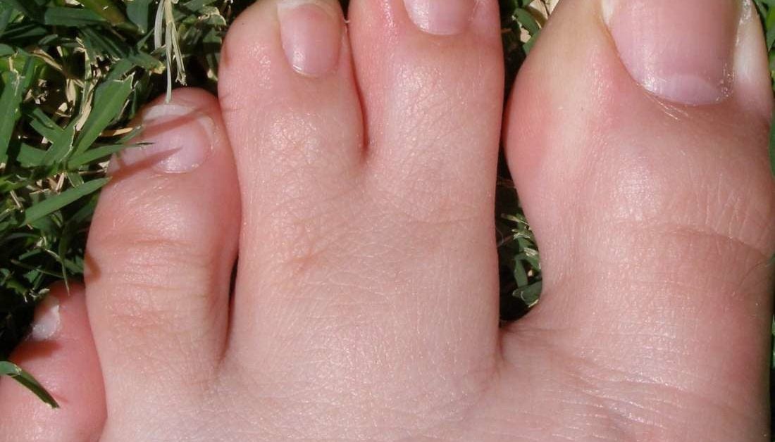 webbed feet human