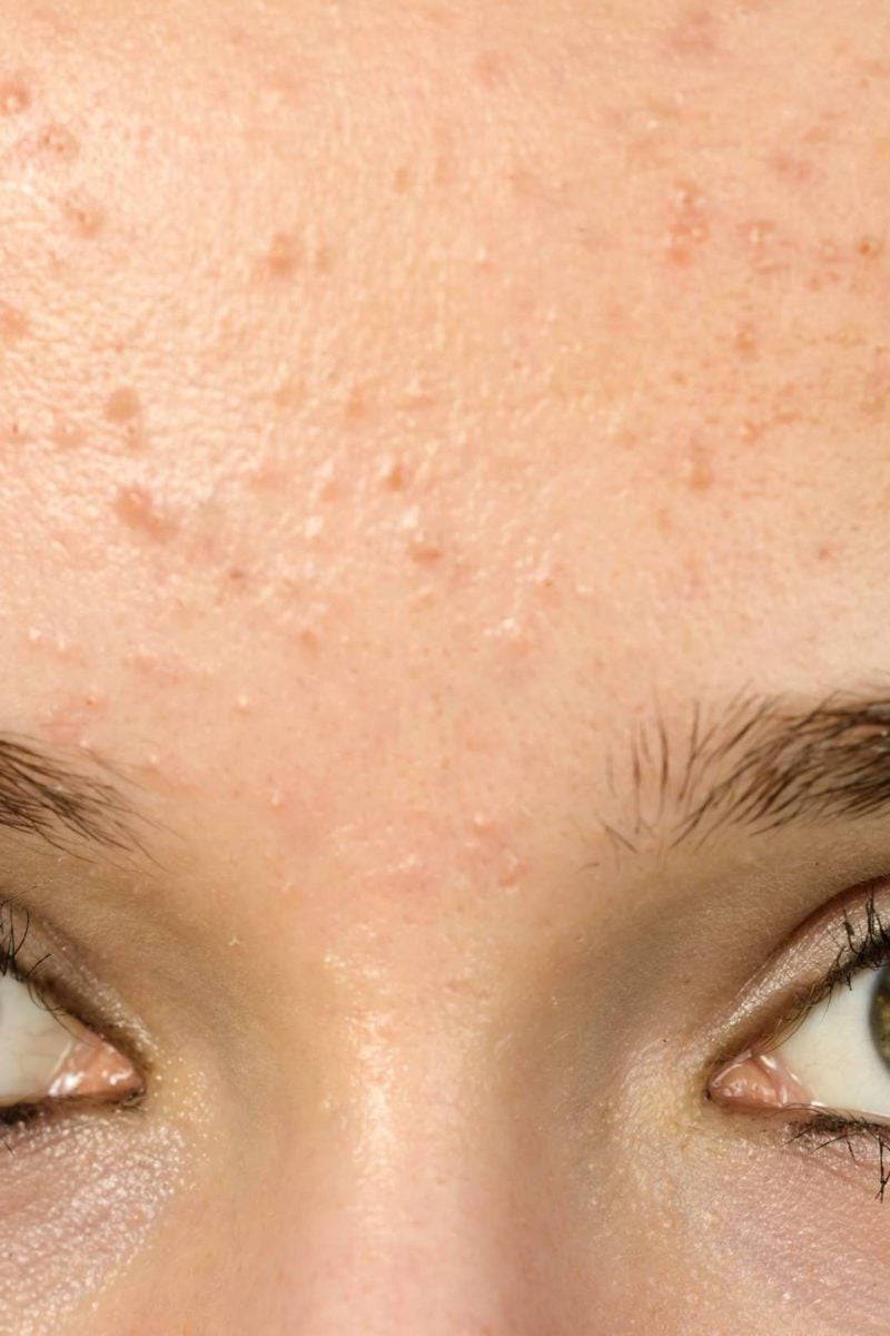 Acne Bumps On Cheeks And Forehead