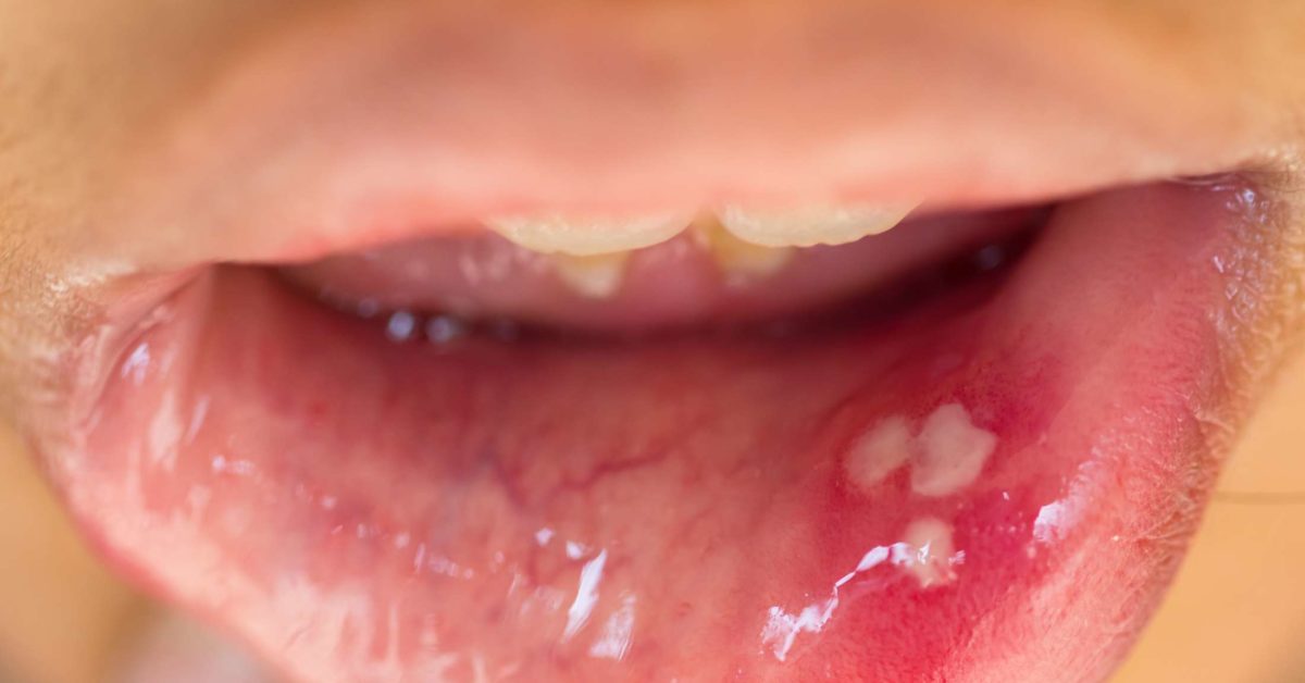 Hpv Bumps On Tongue Symptoms