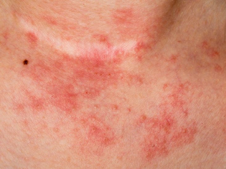 6 Types Of Eczema Symptoms And Causes