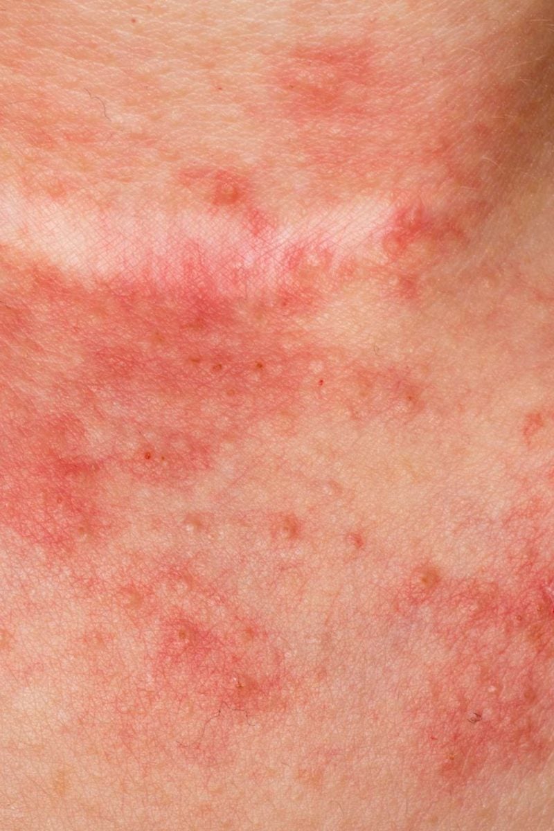 seborrheic dermatitis in children national eczema association