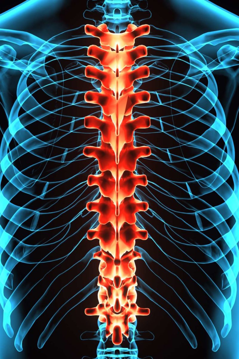 Spinal stroke: Symptoms, causes, recovery, and prognosis