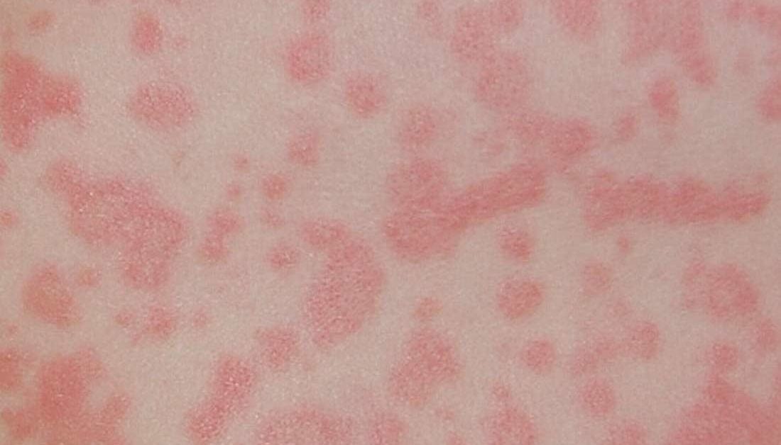 Can You Take Amoxicillin For Scarlet Fever