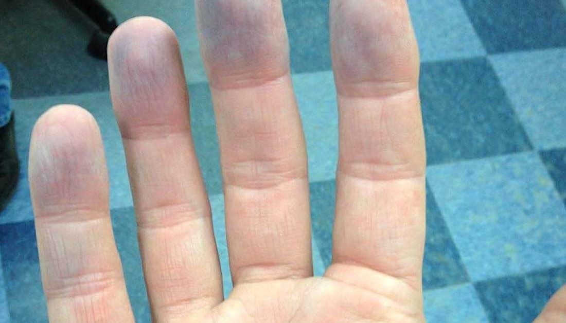 Peripheral Cyanosis Symptoms Causes Diagnosis And Treatment