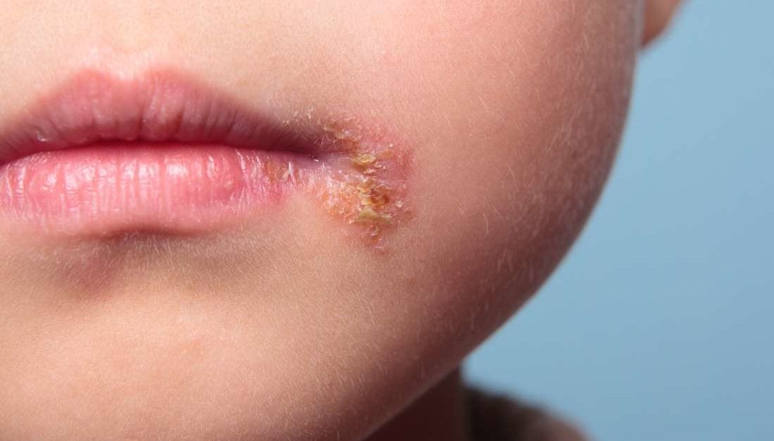 can-babies-get-cold-sores-causes-treatment-and-risks