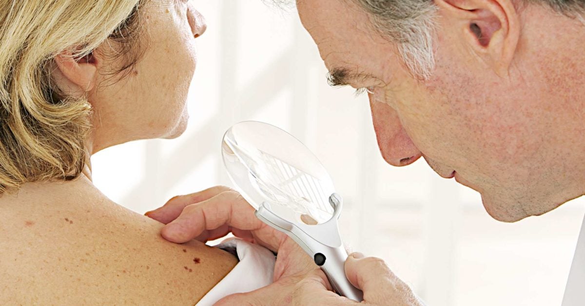 Bleeding Mole Causes And What To Do