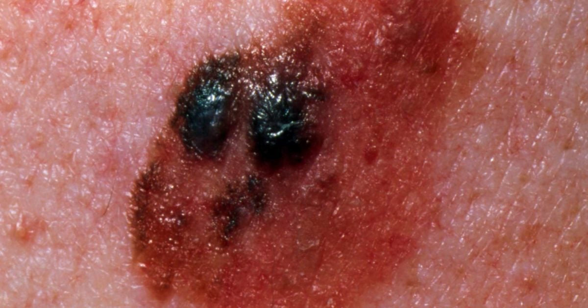 Stage 4 melanoma: Survival rate, pictures, and treatment