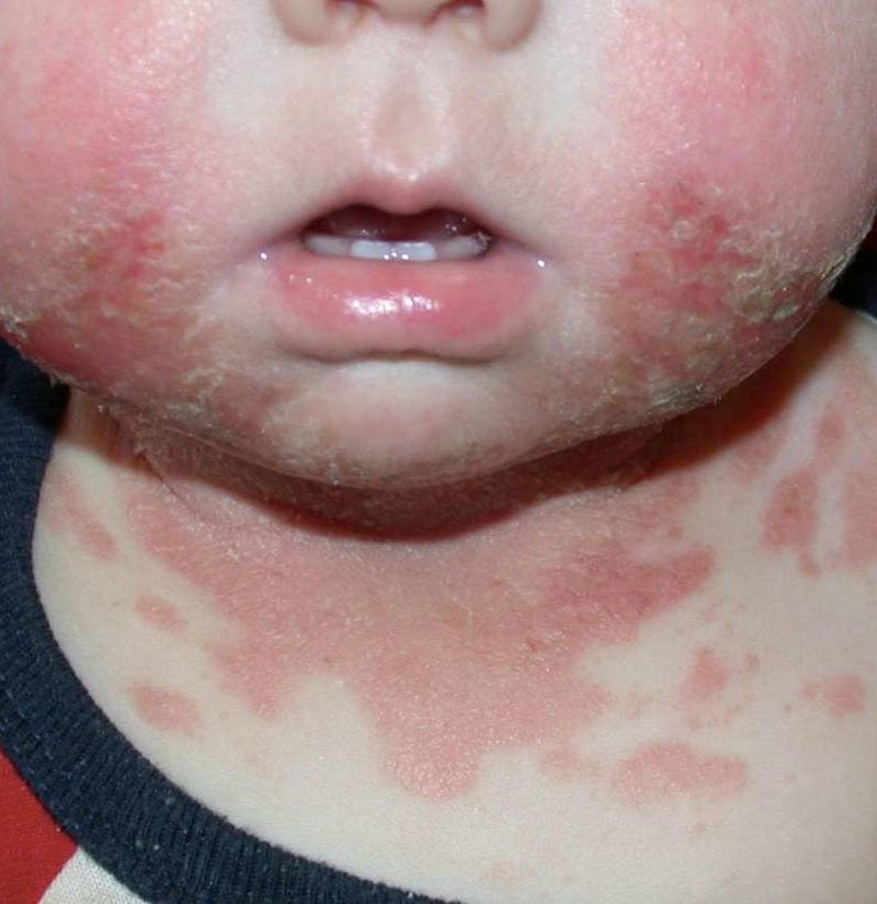 baby powder on neck rash