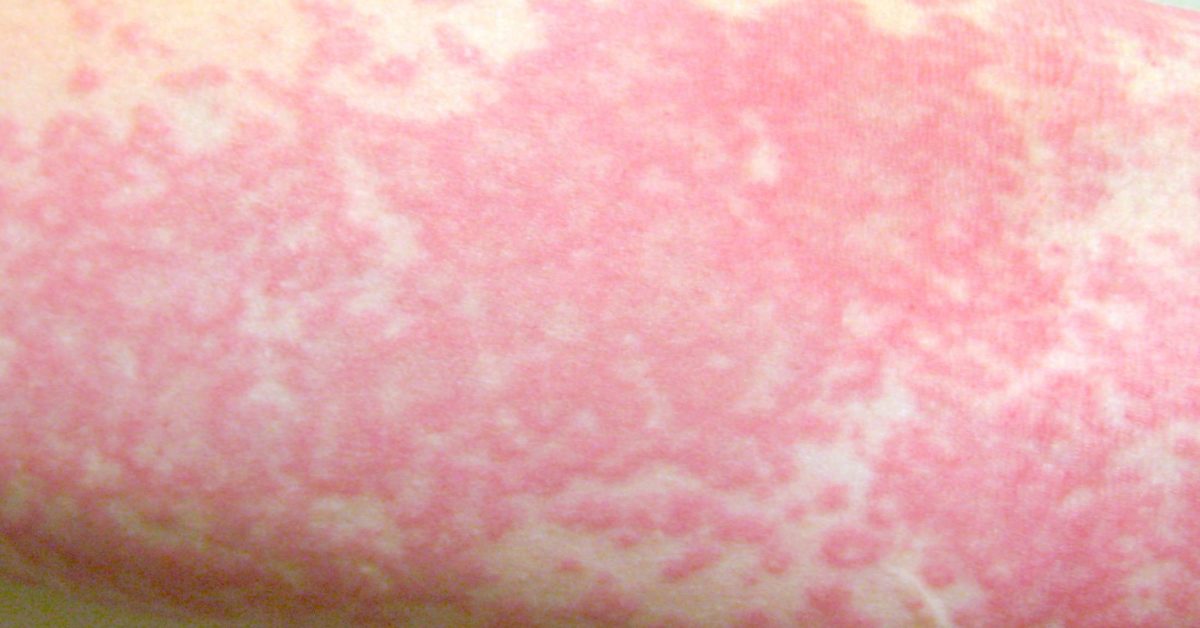 Chlorine rash Symptoms, causes, and treatment