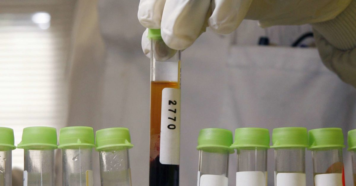 Blood tests for rheumatoid arthritis 8 tests for diagnosis