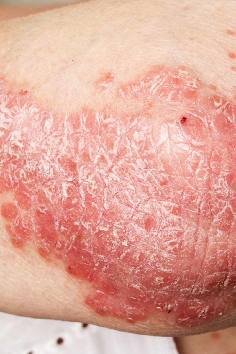 Psoriatic psoriasis 