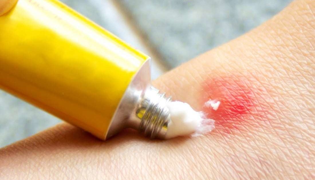 Home Remes For Mosquito Bites 6 Ways That Work Home Remes For Mosquito Bites 6