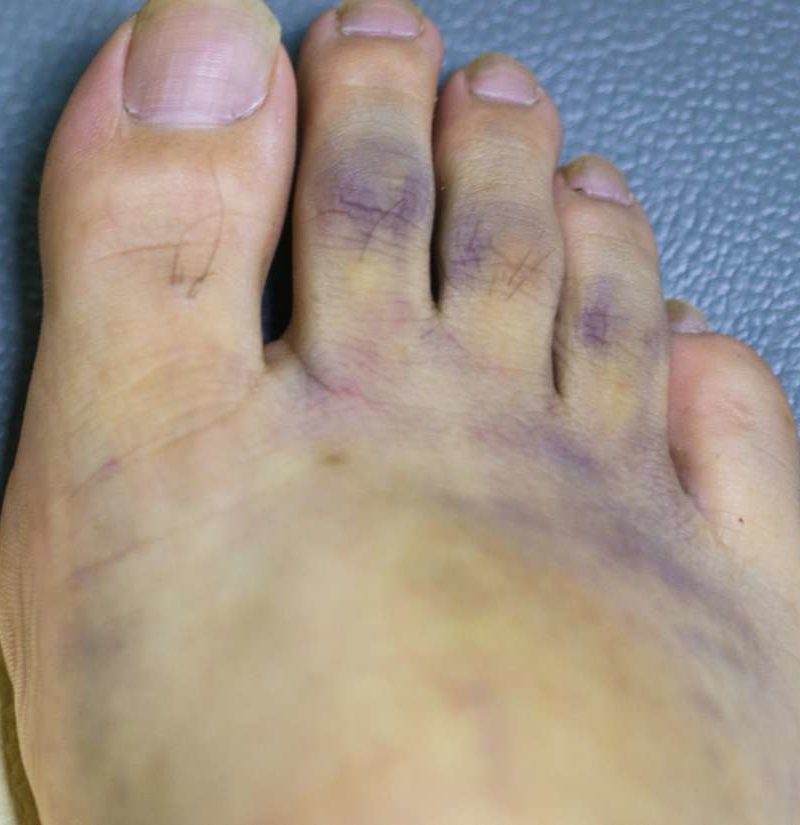 albums-90-images-photos-of-blue-toe-syndrome-full-hd-2k-4k