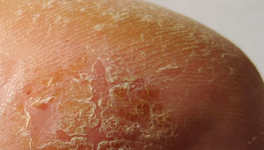 dry patches on foot