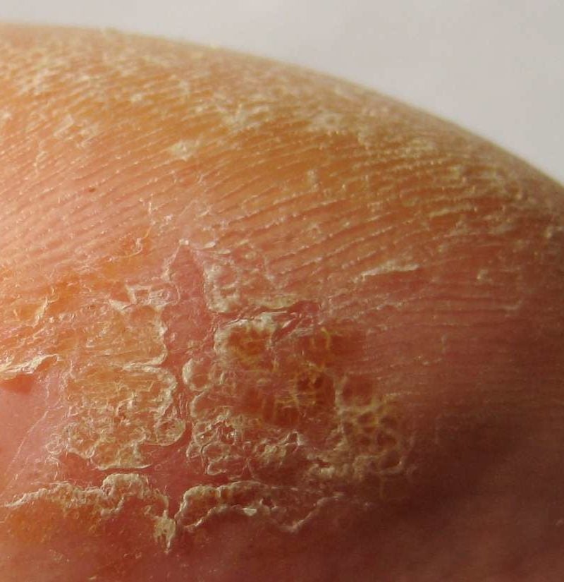 scaling-skin-pictures-causes-treatment-and-prevention