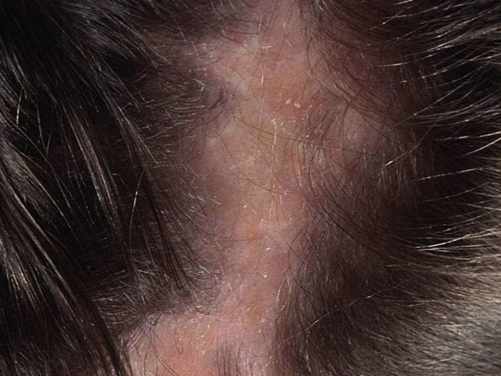 Tingling Scalp Causes Symptoms And Treatment