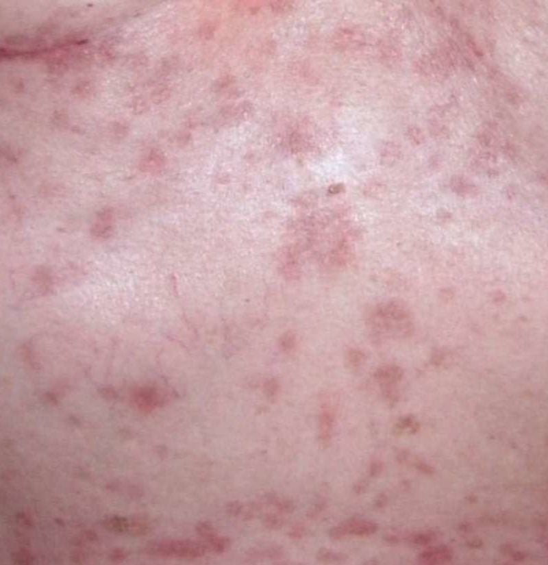 Papular Eczema Symptoms Causes And Treatment