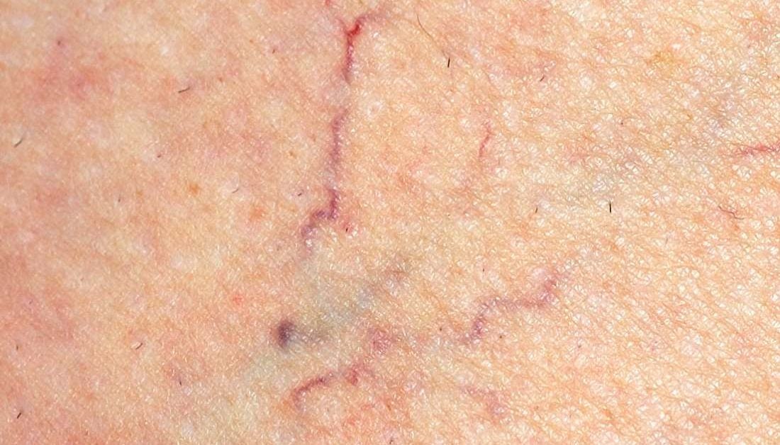 Spider Veins Causes Treatment And Prevention 6925