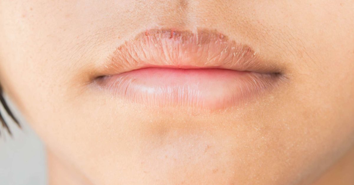 the-best-lip-balms-to-get-rid-of-dry-chapped-lips-youtube