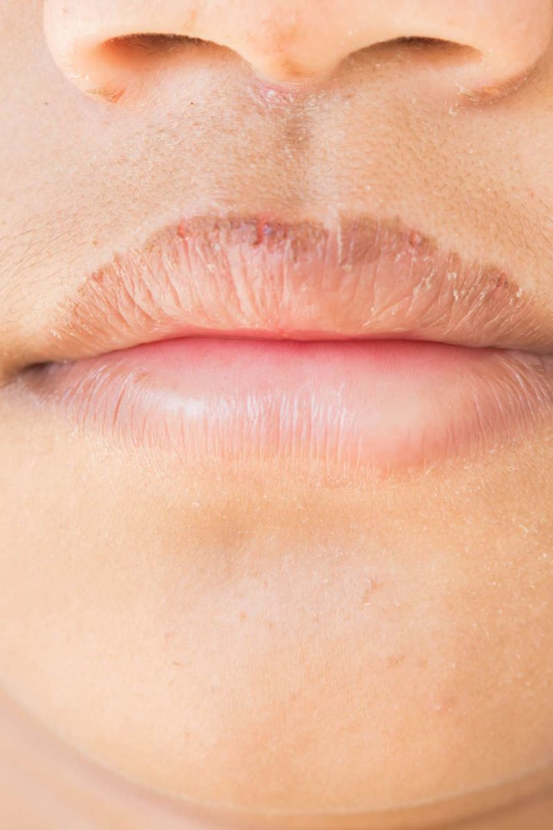 How to get rid of chapped lips: 6 ways